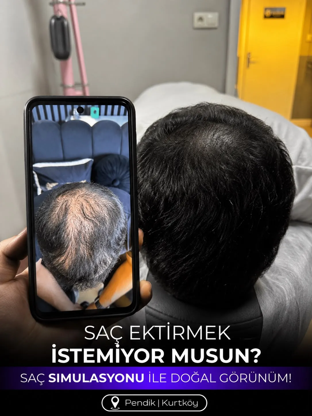 %100 DOĞAL DEĞİŞİMİN  TEK ADRESİ  SAÇ SİMÜLASYONU İLE HAYATINIZA YENİDEN ÖZGÜVEN KATIN! - Fotoğraf Galerisi 2